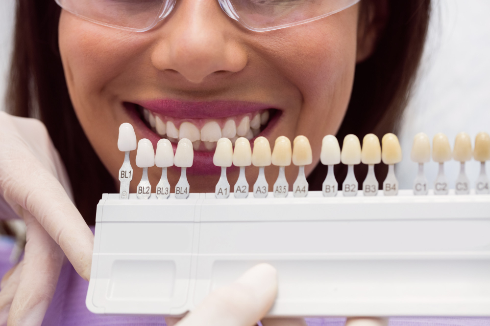 Porcelain Veneers 4