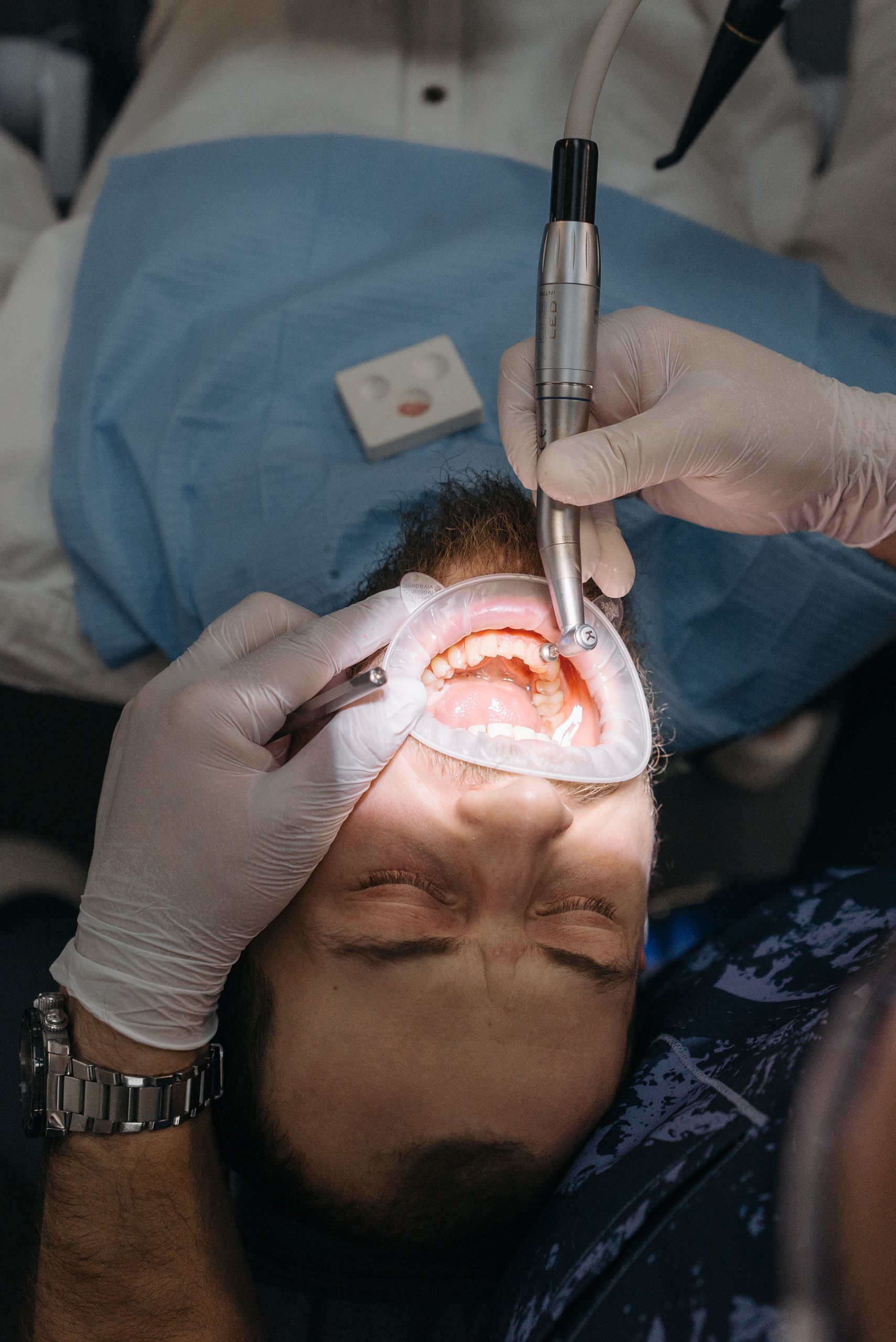 Close-up of a dental procedure with a patient's mouth open and cheek retractor in use.